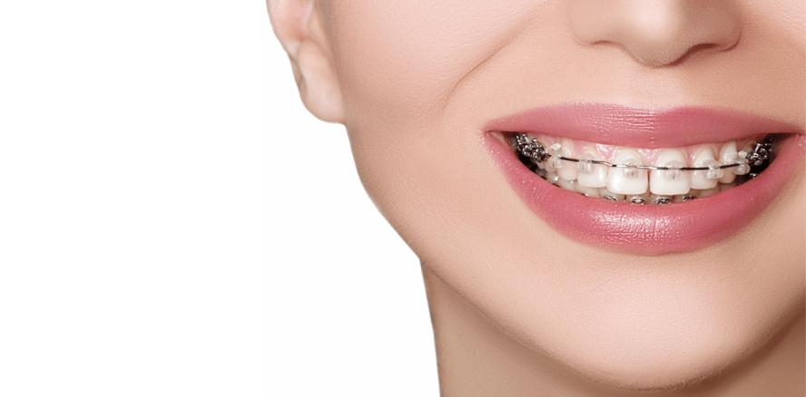 Xylitol bei KFO-Patienten als Zuckerersatz nicht wirksam