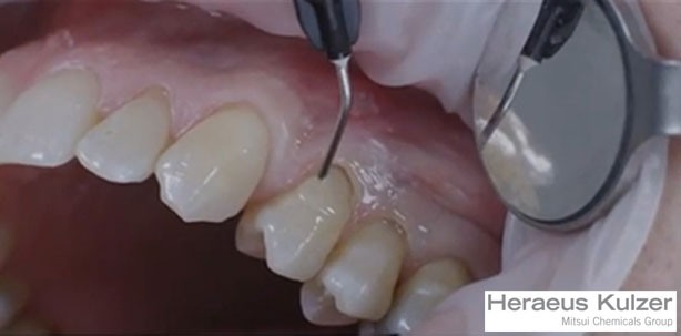 Tipps und Tricks auf dem YouTube-Kanal von Heraeus Kulzer