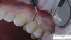 Tipps und Tricks auf dem YouTube-Kanal von Heraeus Kulzer