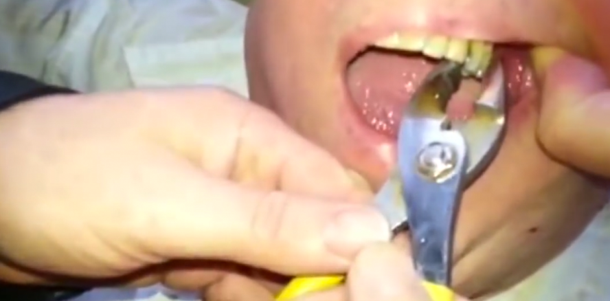 Mann lässt sich mit einer Zange den Zahn ziehen