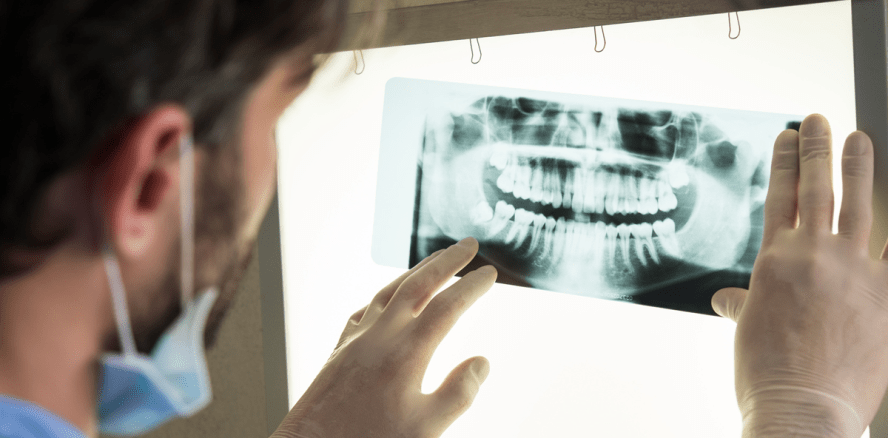 Die postendodontische Erkrankung und die Bedeutung der DVT