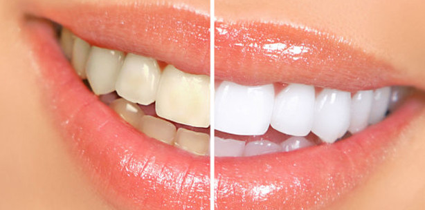 Zahnaufhellung – eine sichere Behandlung?