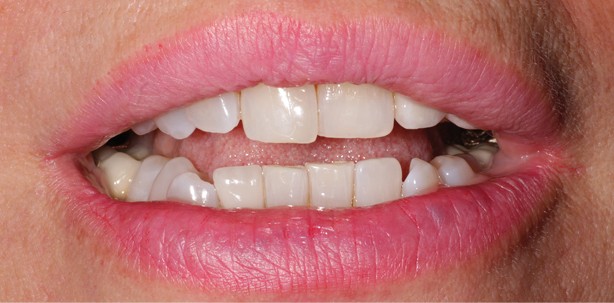 Non-Prep Veneers bei Zahnbreitendifferenz im Frontzahnbereich
