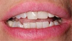 Non-Prep Veneers bei Zahnbreitendifferenz im Frontzahnbereich