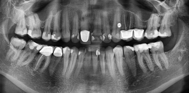 Trauma-Spätfolgen – Zahnerhalt durch DVT bei Osteolyse