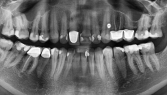 Trauma-Spätfolgen – Zahnerhalt durch DVT bei Osteolyse