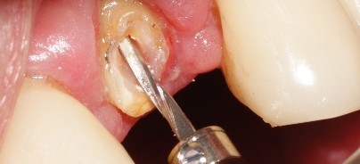 Minimalinvasive Therapie bei der Kronenverlängerung