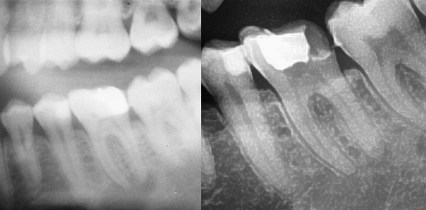 Zahnerhalt bei primär endodontischer Läsion mit apikaler Parodontitis