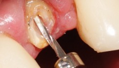 Minimalinvasive Therapie bei der Kronenverlängerung