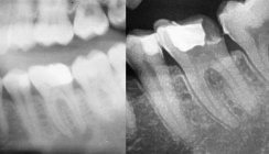 Zahnerhalt bei primär endodontischer Läsion mit apikaler Parodontitis