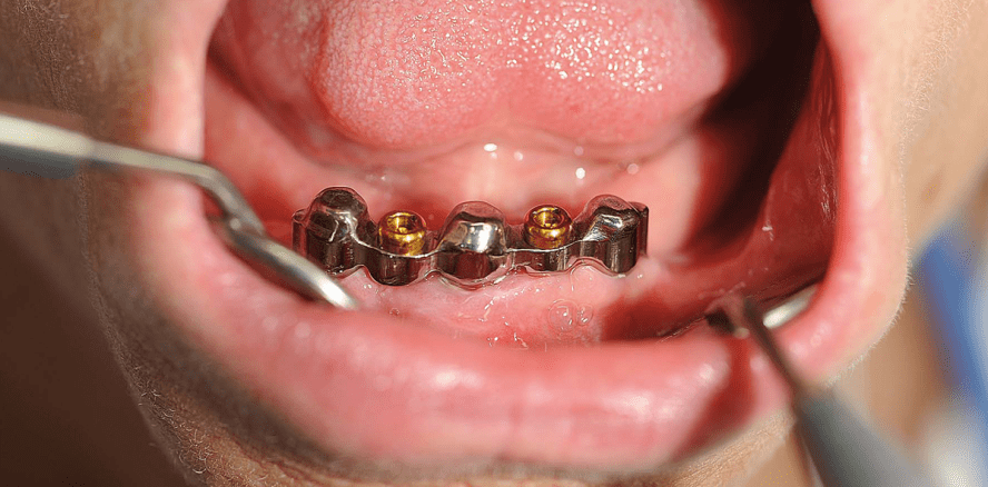 Zahnersatz in 14 Tagen