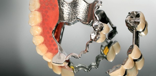 Zahnersatz aus Metall hält durchschnittlich mehr als acht Jahre – ZWP ...