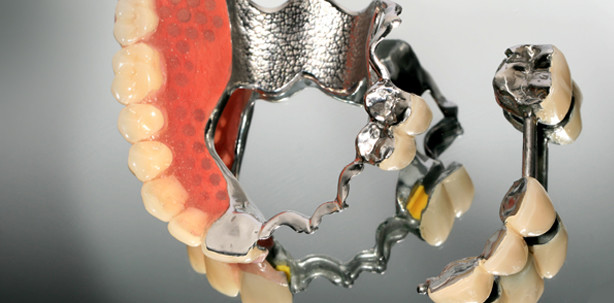 Zahnersatz aus Metall hält durchschnittlich mehr als acht Jahre