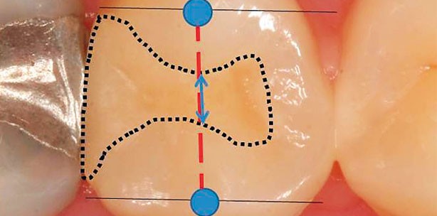 Zahnfarbene Füllungen im Seitenzahnbereich