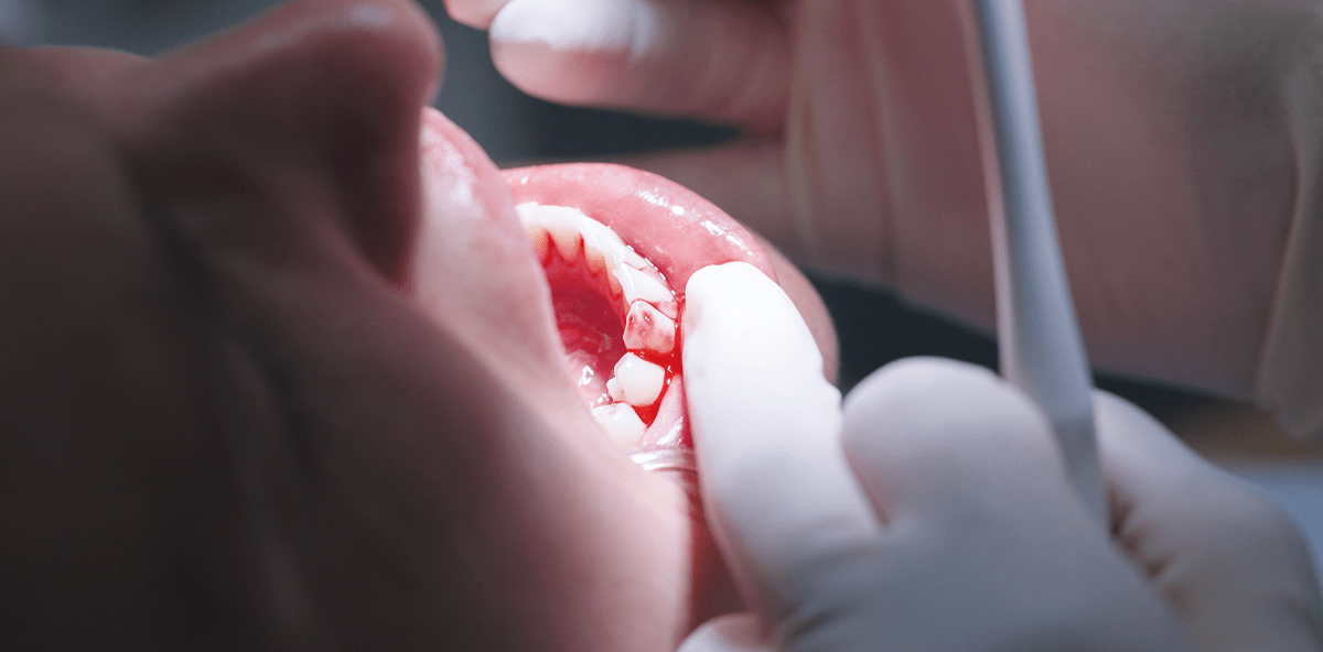 Hormonelle Einflüsse auf Gingiva und Parodontium