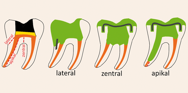 Vertikale Zahnfrakturen: Keinesfalls Ende eines Zahnlebens