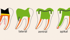 Vertikale Zahnfrakturen: Keinesfalls Ende eines Zahnlebens
