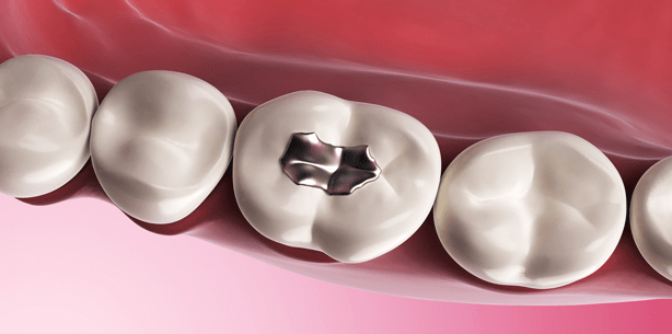 Barmer GEK Zahnreport 2015: Zahnfüllungen halten oft nicht lang