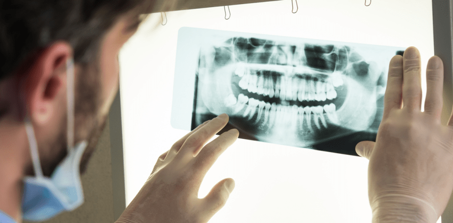 Aus 4 wurden 32: Zahnlos nach chirurgischem Eingriff