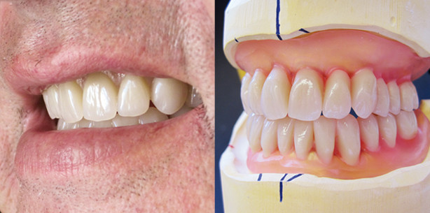 Versorgung eines zahnlosen Patienten