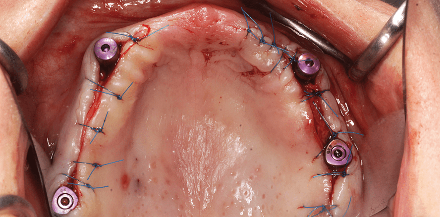 Implantatprothetische Versorgung des zahnlosen Oberkiefers