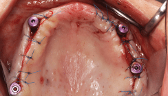 Implantatprothetische Versorgung des zahnlosen Oberkiefers