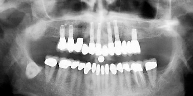 Grundlegende Parameter der Behandlungsplanung beim zahnlosen OK
