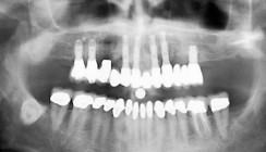 Grundlegende Parameter der Behandlungsplanung beim zahnlosen OK