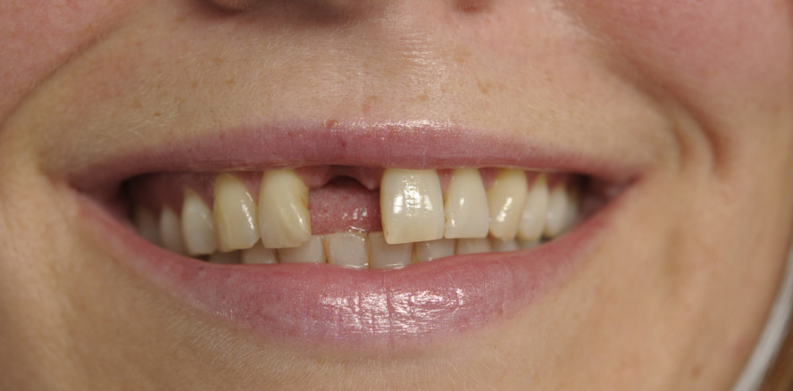 Zahnlücken in Deutschland: Sachsen fehlen am häufigsten Zähne