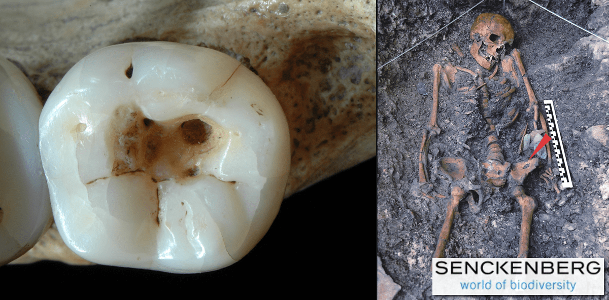 Zahnmedizin ist 5.000 Jahre älter als gedacht