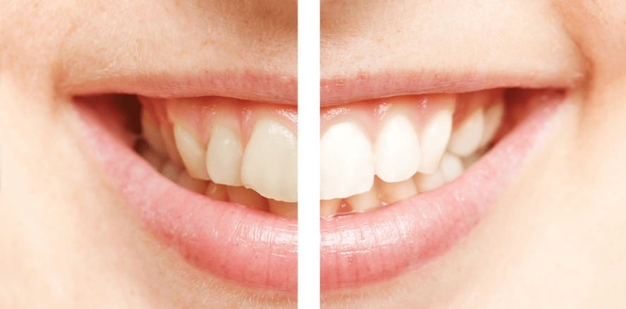 Vor professioneller Zahnreinigung die Kasse nach Zuschüssen fragen