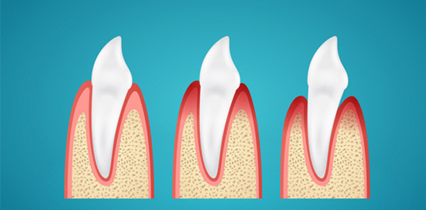 Natürliche Zahnschmelzabnutzung