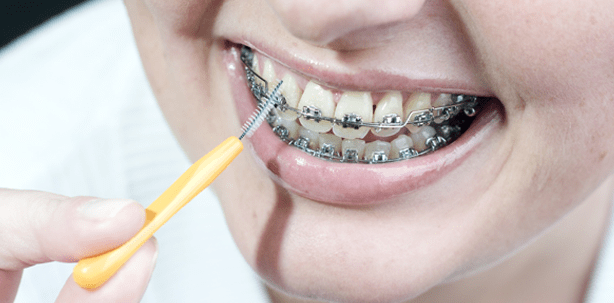 Bei fester Spange nach jedem Essen Zähne putzen