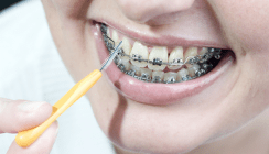 Bei fester Spange nach jedem Essen Zähne putzen