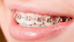 Spangenträger: Mit Fluorid gegen weiße Flecken auf den Zähnen