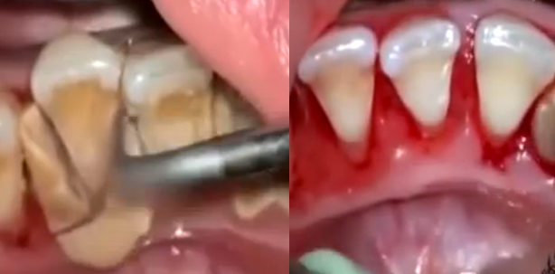 Extrem: Zehn Jahre lang „versteinerte“ Zähne