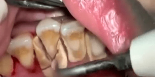 Höllischer Zahnstein: Ein Gebiss wie ein Felsengebirge