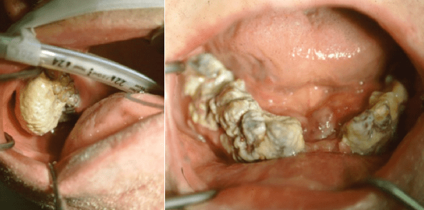 Es geht noch härter: Zahnstein des Grauens