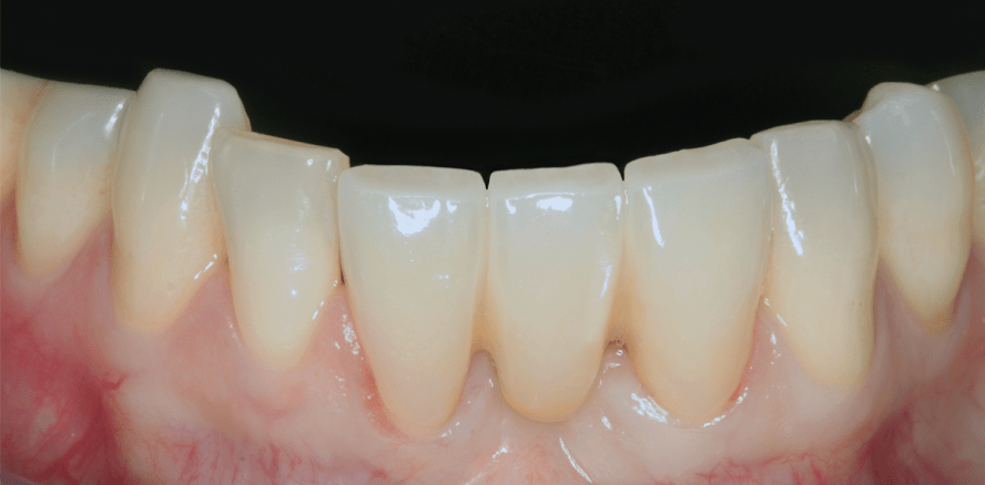 Ästhetische Restauration der Unterkieferfront nach Zahnverlust