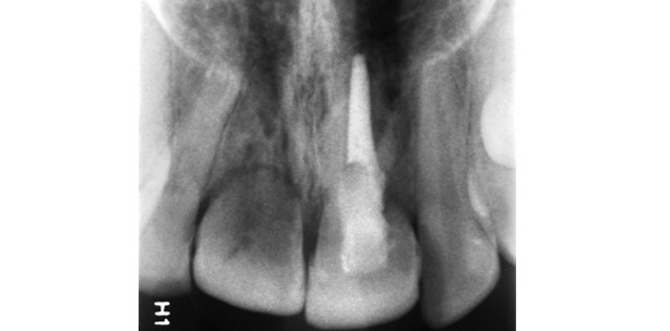Extraktionsindikationen nach Zahntrauma