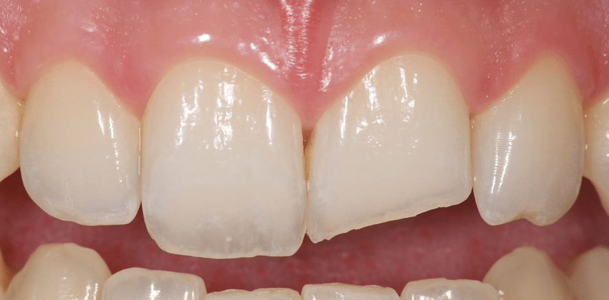 Ästhetik in der Traumatologie – Minimalinvasive Keramikversorgung einer Kronenfraktur