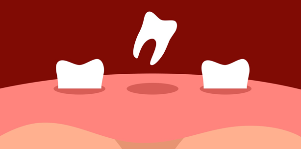 Neue Zähne auf natürliche Weise – Fische machen es vor