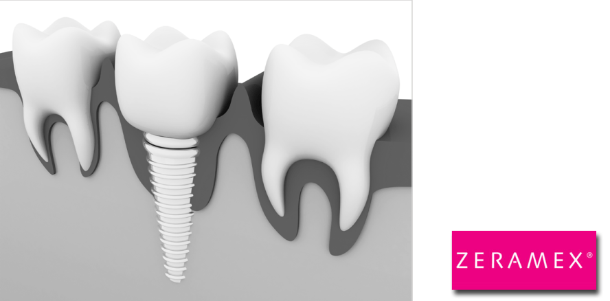 Aktuelle Studienergebnisse zur Osseointegration bei ZERAMEX® Implantaten
