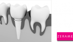Aktuelle Studienergebnisse zur Osseointegration bei ZERAMEX® Implantaten