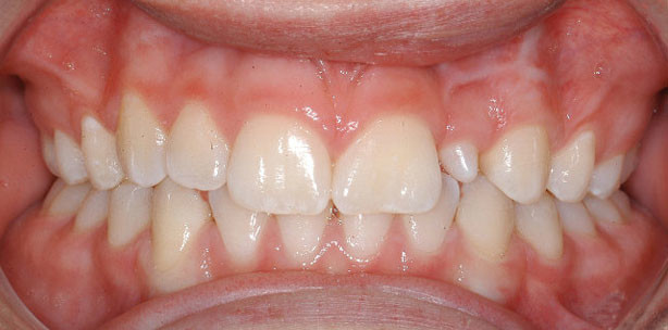 Lückenschluss mit Miniimplantaten im lateralen Hartgaumen