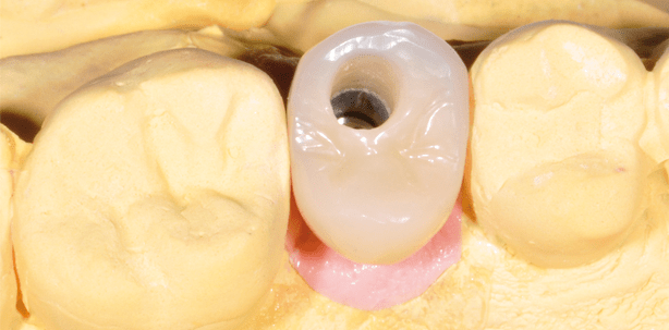 Zirkonverstärktes Komposit – ein universell einsetzbares Material