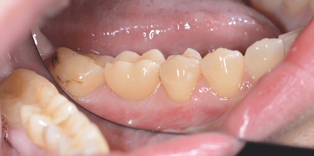 Keramikimplantat bevorzugt