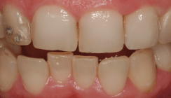 Moderne Zirkonoxidvarianten für optimale ästhetische Ergebnisse