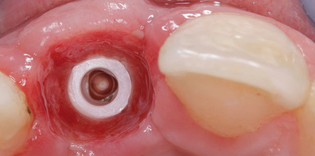 Ästhetische Zahnversorgung auf ­zweiteiligen Zirkonoxidimplantaten