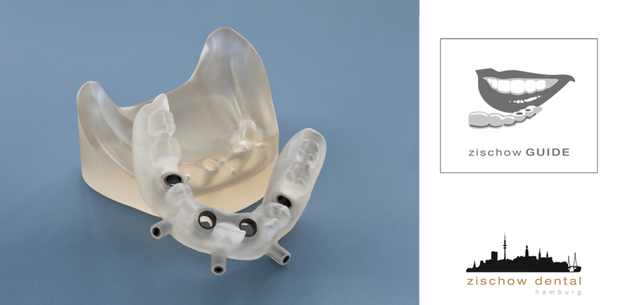 Sicher Implantieren mit zischow GUIDE®